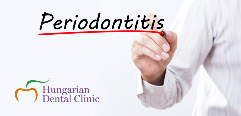 Periodontal Disease and Periodontitis