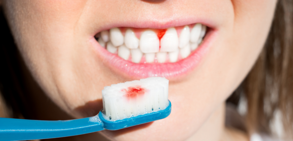periodontal disease - bleed